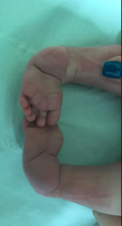 Soles of a baby's feet with clubfoot