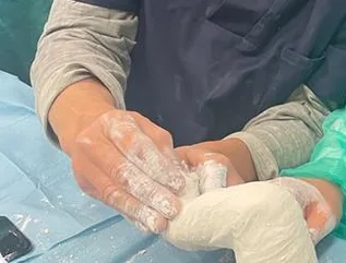 Aplicación de un yeso moldeado durante el tratamiento